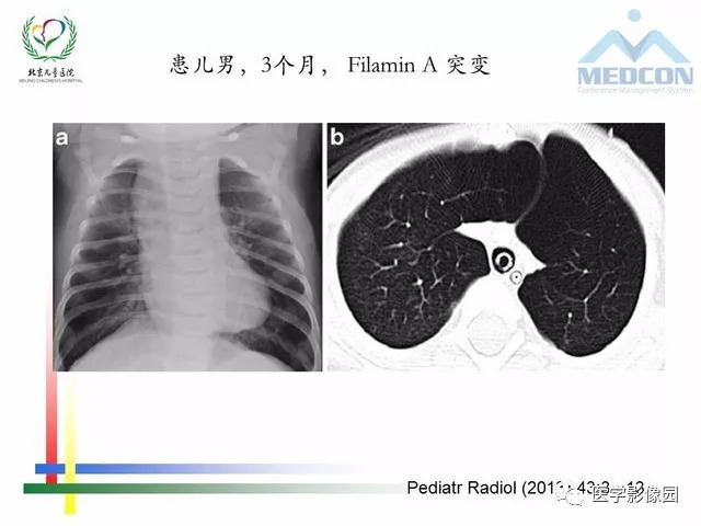 间质性肺病最新特效药研发进展与应用探索